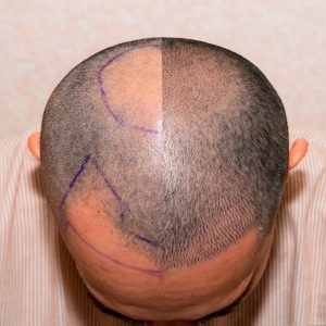 IMPLANTES CAPILARES Hands on